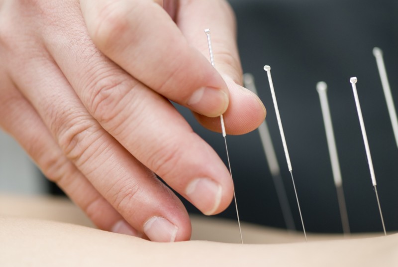 Acupuncture-Treatment-800