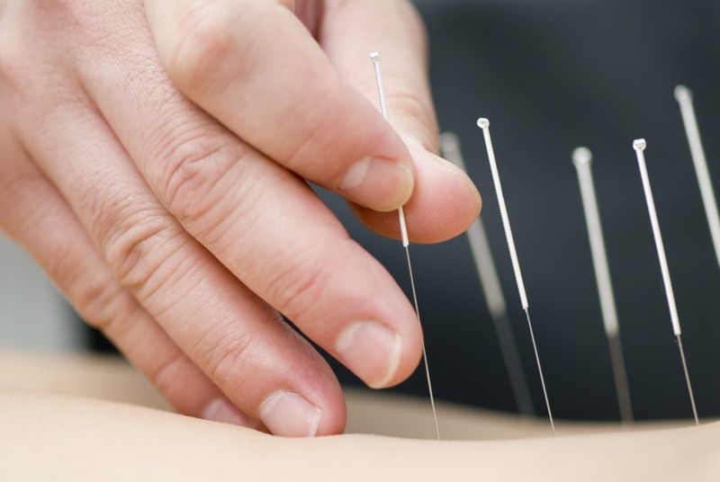 Acupuncture Treatment 800