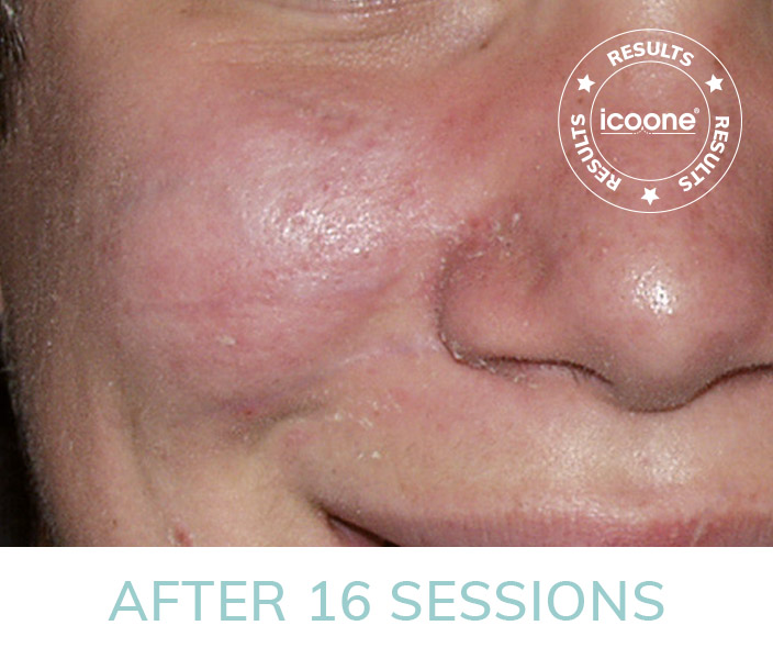 Non-Invasive Body Contouring with ICOONE beauty laser