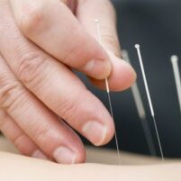 Acupuncture treatment 800