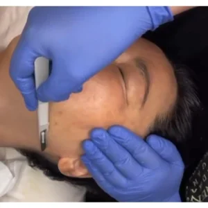 Dermaplaning